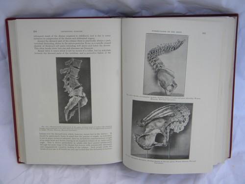 old 1920 medical text orthopedic surgery from doctor's library w/engravings