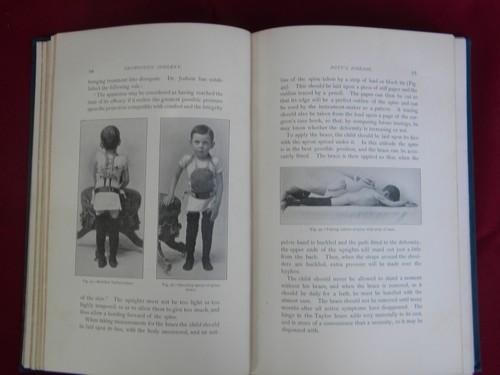 photo of 1890s antique doctor or surgeon's medical textbook - Orthopedic Surgery #1