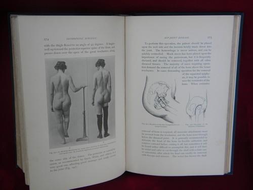 photo of 1890s antique doctor or surgeon's medical textbook - Orthopedic Surgery #3