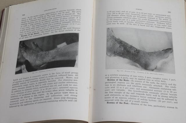 photo of 1920s vintage medical textbook, Diseases of the Skin, gruesome photos #4