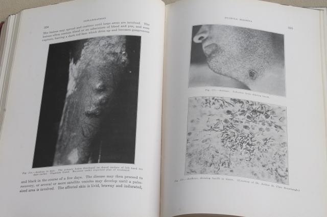 photo of 1920s vintage medical textbook, Diseases of the Skin, gruesome photos #5