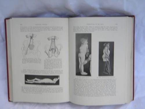 photo of old 1920 medical text orthopedic surgery from doctor's library w/engravings #1