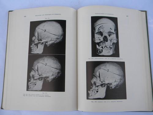 photo of vintage dentist textbook pulling and extracting teeth 350+ illustrations #4